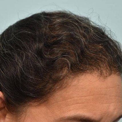 micro-hair-restoration-transplant-miami-carlos-spera-20