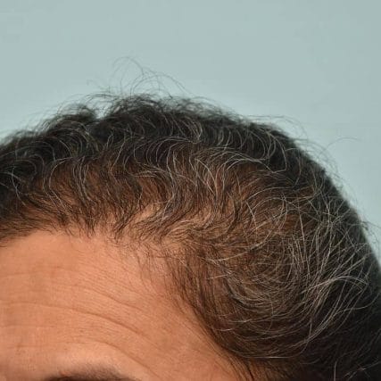 micro-hair-restoration-transplant-miami-carlos-spera-21