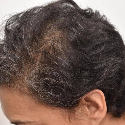 micro-hair-restoration-transplant-miami-carlos-spera-22