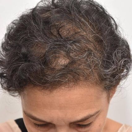 micro-hair-restoration-transplant-miami-carlos-spera-23