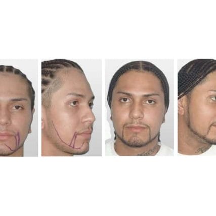 micro-hair-restoration-transplant-miami-carlos-spera-3