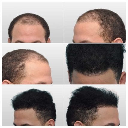 micro-hair-restoration-transplant-miami-carlos-spera-4