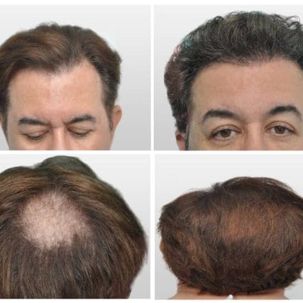 micro-hair-restoration-transplant-miami-carlos-spera-5