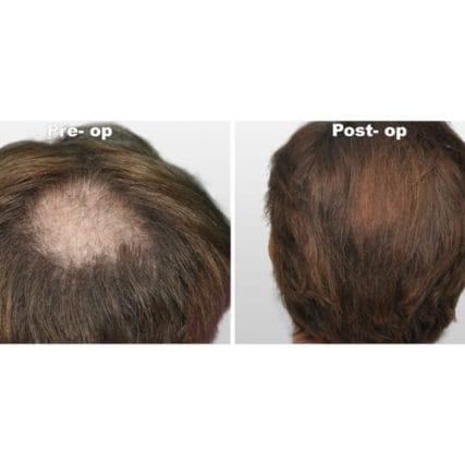 micro-hair-restoration-transplant-miami-carlos-spera-6