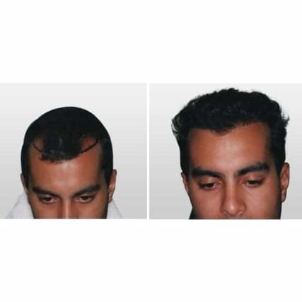 micro-hair-restoration-transplant-miami-carlos-spera-7