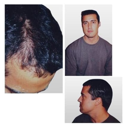 micro-hair-restoration-transplant-miami-carlos-spera-9