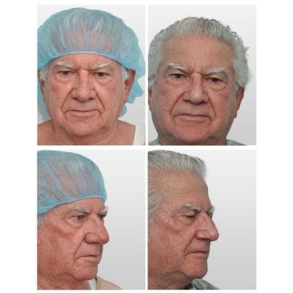 rhinophyma-miami-carlos-spera-1