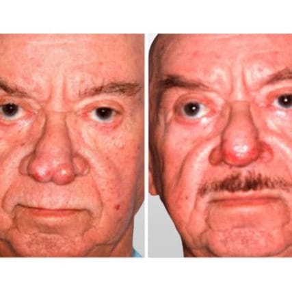 rhinophyma-miami-carlos-spera-2