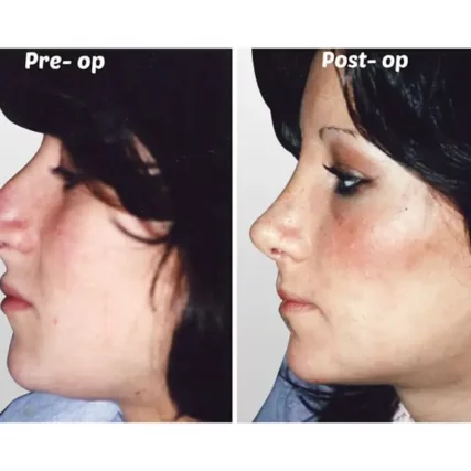 rhinoplasty-nose-surgery-miami-carlos-spera-17