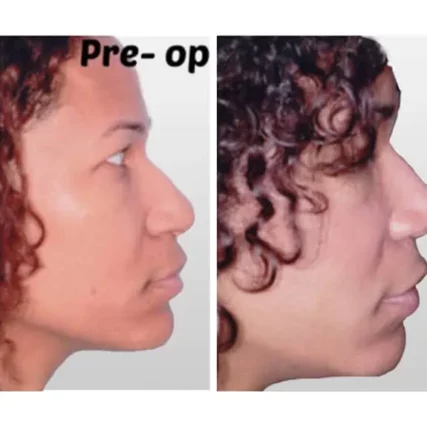 rhinoplasty-nose-surgery-miami-carlos-spera-19