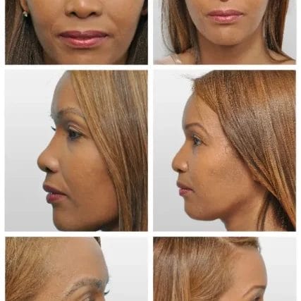 rhinoplasty-nose-surgery-miami-carlos-spera-2