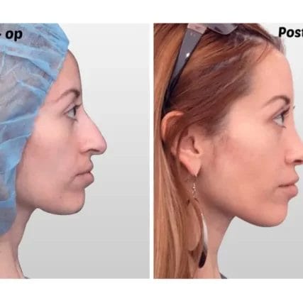 rhinoplasty-nose-surgery-miami-carlos-spera-20