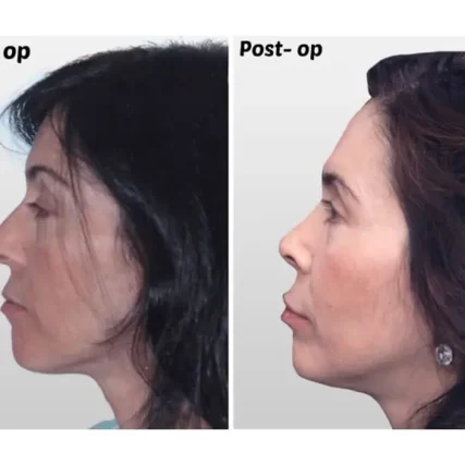 rhinoplasty-nose-surgery-miami-carlos-spera-21