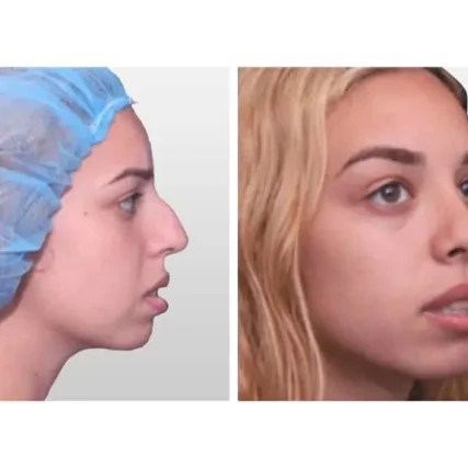 rhinoplasty-nose-surgery-miami-carlos-spera-24