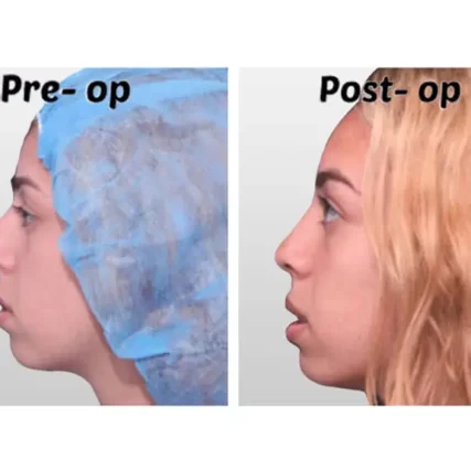 rhinoplasty-nose-surgery-miami-carlos-spera-25
