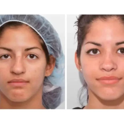 rhinoplasty-nose-surgery-miami-carlos-spera-26