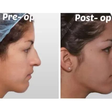rhinoplasty-nose-surgery-miami-carlos-spera-27