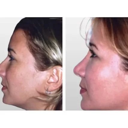 rhinoplasty-nose-surgery-miami-carlos-spera-28