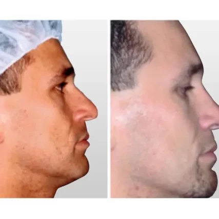 rhinoplasty-nose-surgery-miami-carlos-spera-30