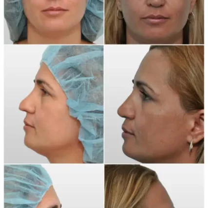 rhinoplasty-nose-surgery-miami-carlos-spera-4