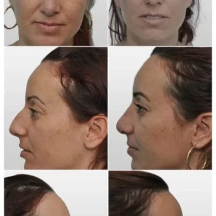 rhinoplasty-nose-surgery-miami-carlos-spera-5