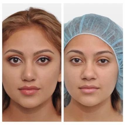 rhinoplasty-nose-surgery-miami-carlos-spera-6