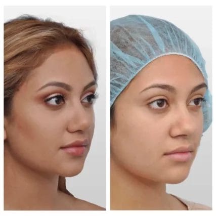 rhinoplasty-nose-surgery-miami-carlos-spera-7