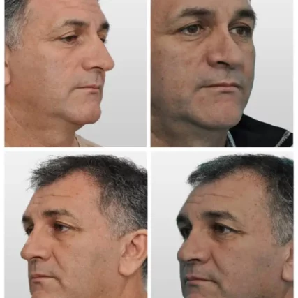 rhinoplasty-nose-surgery-miami-carlos-spera-8