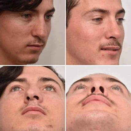 rinoplastia-in-miami