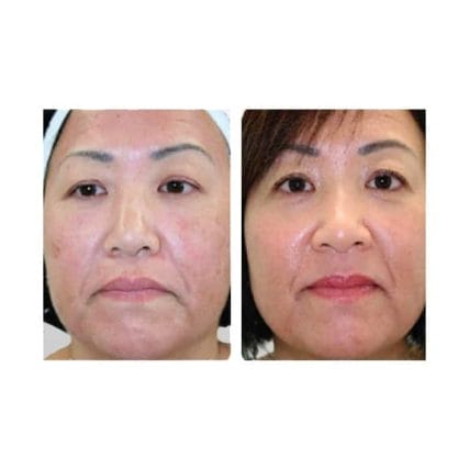 sciton-laser-skin-resurfacing-miami-carlos-spera-10