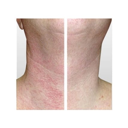 sciton-laser-skin-resurfacing-miami-carlos-spera-12