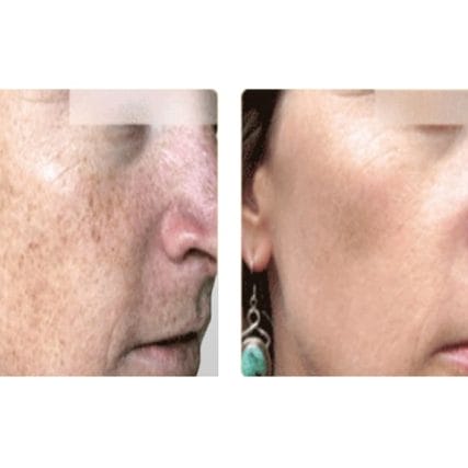 sciton-laser-skin-resurfacing-miami-carlos-spera-13
