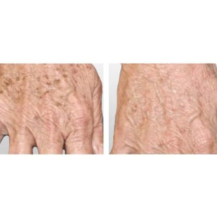 sciton-laser-skin-resurfacing-miami-carlos-spera-14