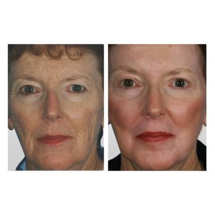 sciton-laser-skin-resurfacing-miami-carlos-spera-4