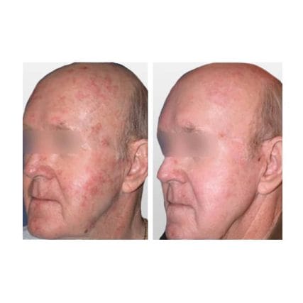 sciton-laser-skin-resurfacing-miami-carlos-spera-5