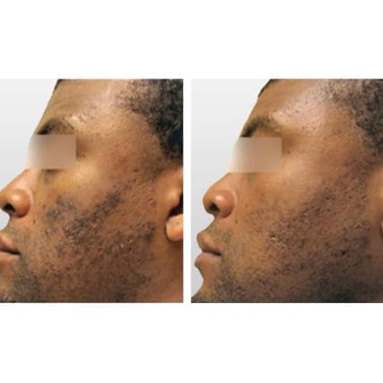 sciton-laser-skin-resurfacing-miami-carlos-spera-6