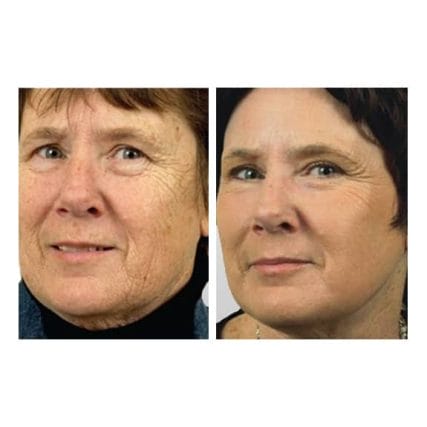 sciton-laser-skin-resurfacing-miami-carlos-spera-7