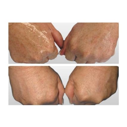 sciton-laser-skin-resurfacing-miami-carlos-spera-8