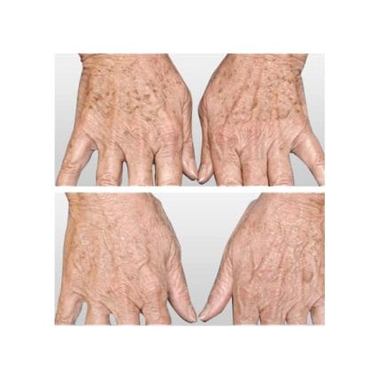 sciton-laser-skin-resurfacing-miami-carlos-spera-9