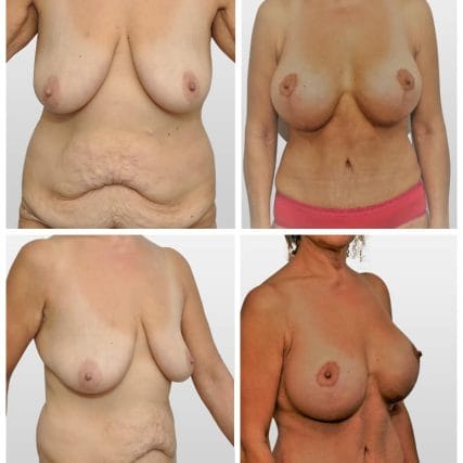 tummy-tuck-addominoplasty-miami-carlos-spera-1