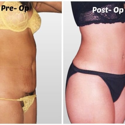 tummy-tuck-addominoplasty-miami-carlos-spera-11