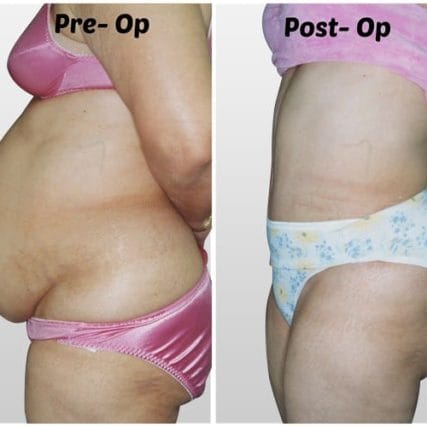 tummy-tuck-addominoplasty-miami-carlos-spera-12