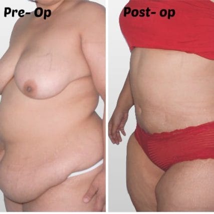 tummy-tuck-addominoplasty-miami-carlos-spera-13