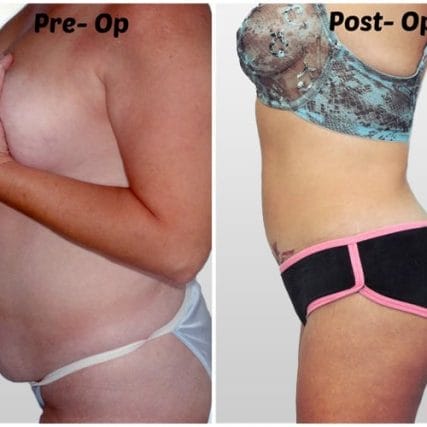 tummy-tuck-addominoplasty-miami-carlos-spera-14