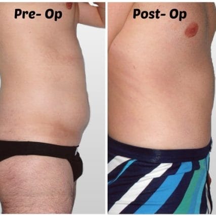 tummy-tuck-addominoplasty-miami-carlos-spera-17