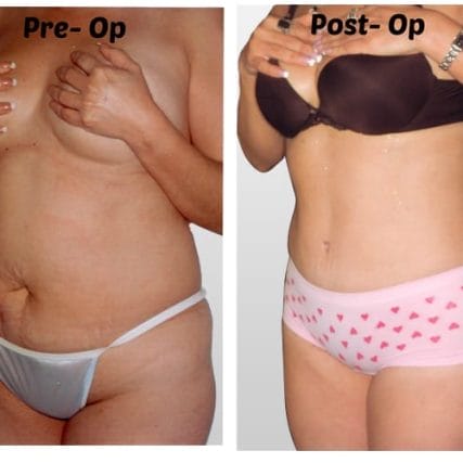 tummy-tuck-addominoplasty-miami-carlos-spera-19