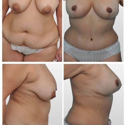 tummy-tuck-addominoplasty-miami-carlos-spera-2