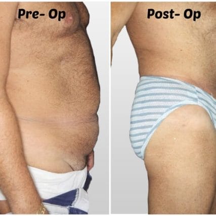 tummy-tuck-addominoplasty-miami-carlos-spera-21