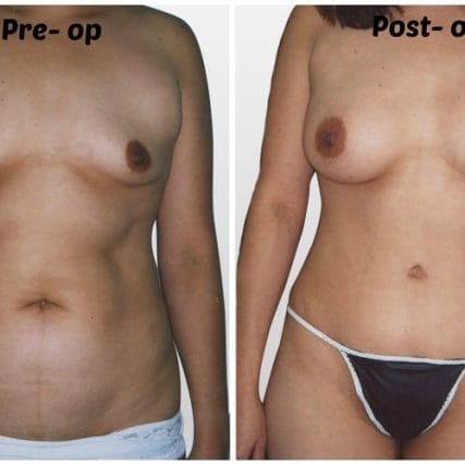 tummy-tuck-addominoplasty-miami-carlos-spera-22