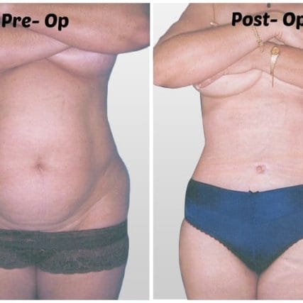 tummy-tuck-addominoplasty-miami-carlos-spera-23